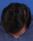 After Hair Transplant&nbsp;Front